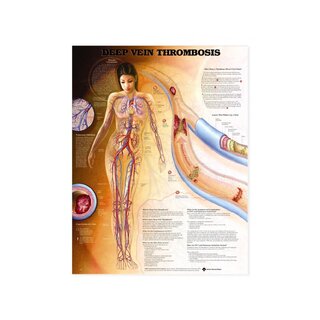 Mélyvénás trombózis (DVT) - poszter
