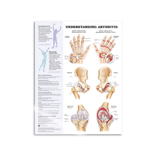Arthritis laminált angol
