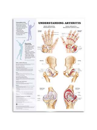 Arthritis laminált angol